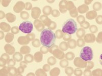 leukemia_472_355.jpg